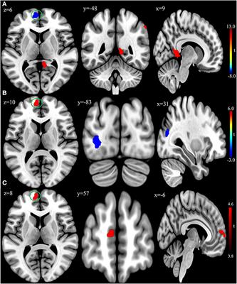 Corrigendum: rTMS induces brain functional and structural alternations in schizophrenia patient with auditory verbal hallucination